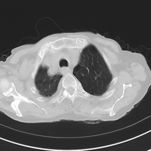Cavitating pneumonia - lingular segments (Radiopaedia 34386-35678 Axial lung window 12).png