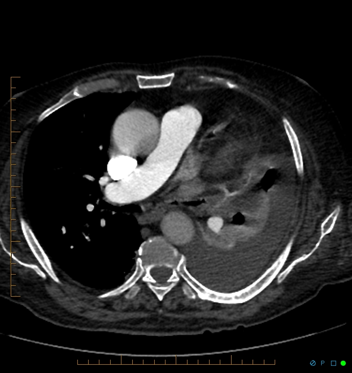 Cavitating pulmonary infarction (Radiopaedia 54634-60849 Axial C+ CTPA 36).jpg