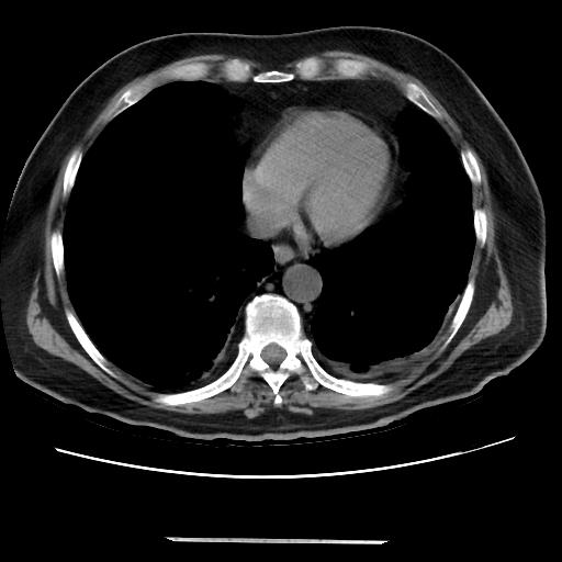 Cavitating pulmonary metastases (Radiopaedia 89545-106544 Axial non-contrast 40).jpg
