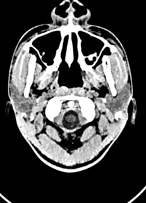 Cavum septum pellucidum and cavum vergae (Radiopaedia 77797-90060 Axial Brain Window 4).jpg
