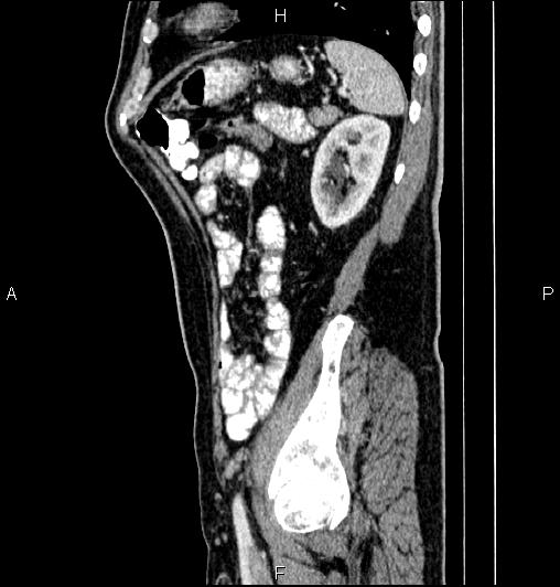 Cecal adenocarcinoma (Radiopaedia 85324-100916 E 72).jpg
