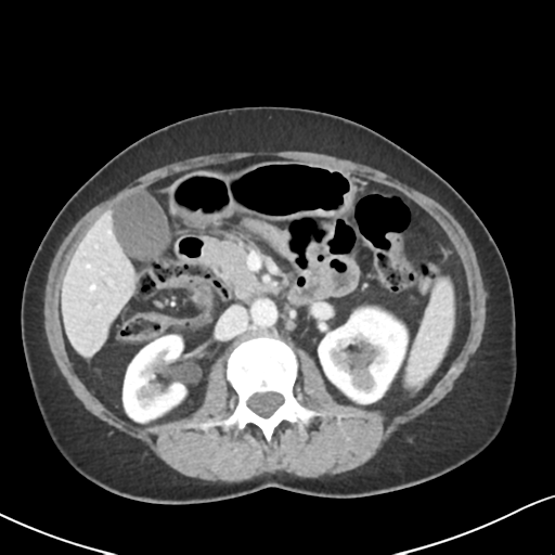 Cecal internal hernia through the foramen of Winslow (Radiopaedia 44820-48651 B 31).png