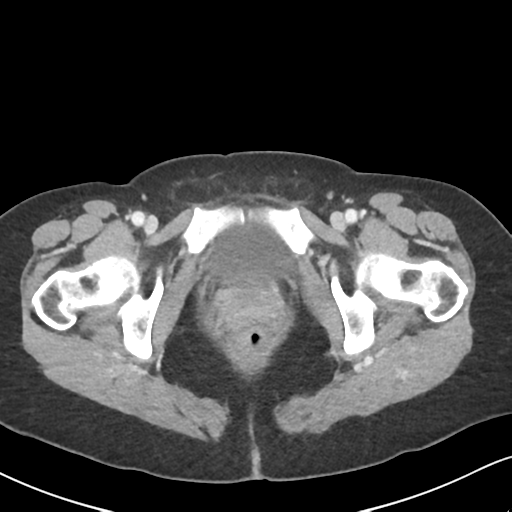 Cecal internal hernia through the foramen of Winslow (Radiopaedia 44820-48651 B 77).png