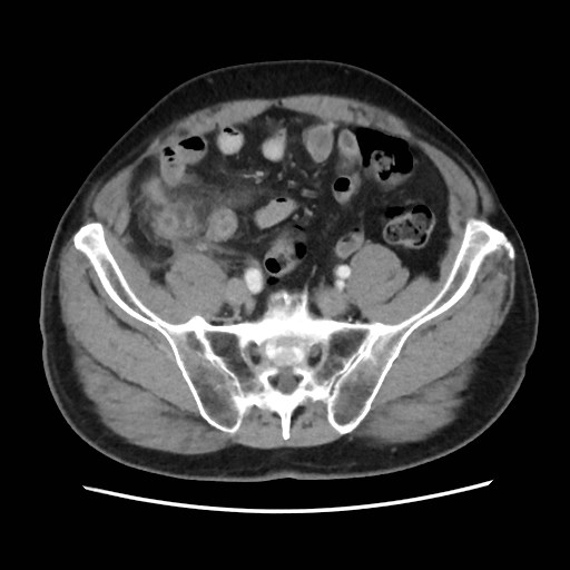 Cecal mass causing appendicitis (Radiopaedia 59207-66531 A 66).jpg