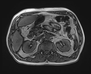 Cecal mass causing appendicitis (Radiopaedia 59207-66532 D 52).jpg