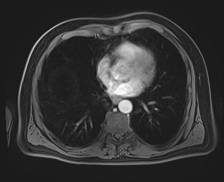 Cecal mass causing appendicitis (Radiopaedia 59207-66532 T1 C+ PV phase 11).jpg