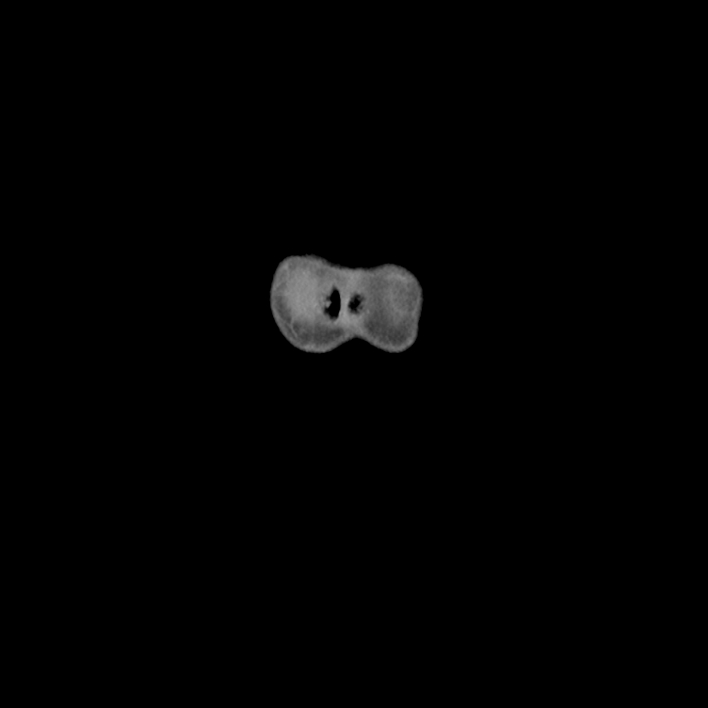 Cecal volvulus (Radiopaedia 69527-79408 B 3).jpg