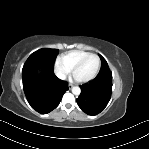 Cecum hernia through the foramen of Winslow (Radiopaedia 46634-51112 A 4).png