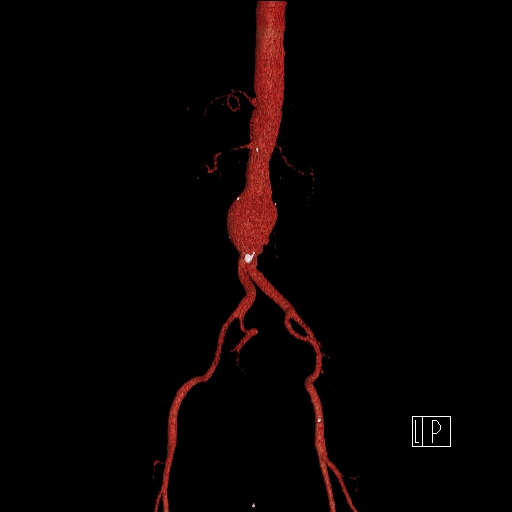 File:Celiac artery compression by the diaphragmatic crurae (Radiopaedia 31739-32666 3D CTA 11).jpg