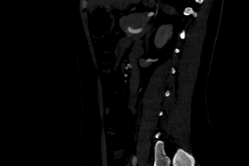 Celiac artery compression syndrome (Radiopaedia 47538-52152 B 74).jpg