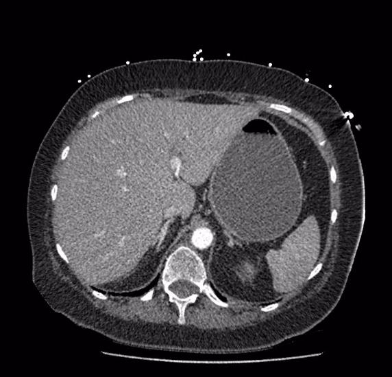 File:Celiac artery severe stenosis and dissection (Radiopaedia 44128-47842 B 17).jpg
