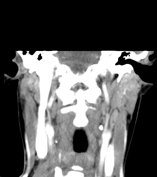 Cemento-ossifying fibroma (Radiopaedia 46243-50643 Coronal C+ delayed 41).png