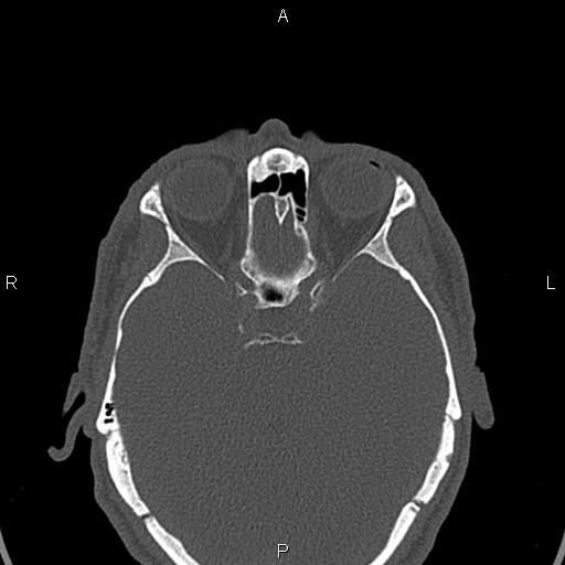 File:Central giant cell granuloma (Radiopaedia 83346-97761 Axial bone window 62).jpg