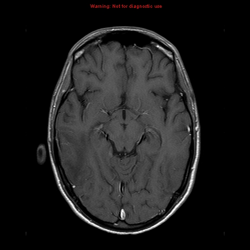File:Central nervous system vasculitis (Radiopaedia 8410-9235 Axial T1 C+ 10).jpg