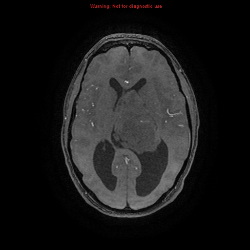 Central neurocytoma (Radiopaedia 13188-13206 Axial MRA 38).jpg