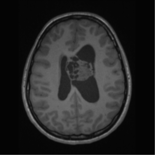 File:Central neurocytoma (Radiopaedia 37664-39557 Axial T1 47).png