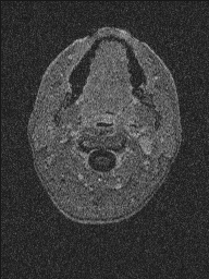 Central neurocytoma (Radiopaedia 56690-63469 Axial T1 C+ 170).jpg