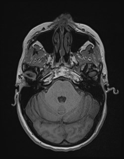 Central neurocytoma (Radiopaedia 84497-99872 Axial T1 57).jpg