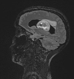File:Central neurocytoma (Radiopaedia 84497-99872 Sagittal Flair + Gd 62).jpg
