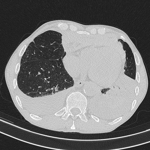 Central venous catheter tip extravasation (Radiopaedia 82828-97113 Axial lung window 63).jpg