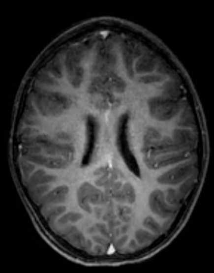 Cerebellar abscess (Radiopaedia 73727-84563 Axial T1 C+ fat sat 74).jpg