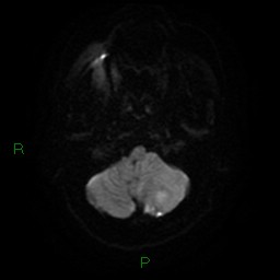 Cerebellar abscess (Radiopaedia 78135-90678 Axial DWI 5).jpg