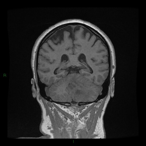 Cerebellar abscess (Radiopaedia 78135-90678 Coronal T1 C+ 108).jpg