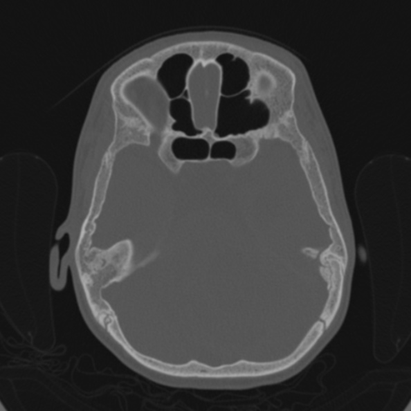 Cerebellar abscess secondary to mastoiditis (Radiopaedia 26284-26413 Axial bone window 75).jpg