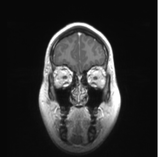 Cerebellar ependymoma complicated by post-operative subdural hematoma (Radiopaedia 83322-97736 Coronal T1 C+ 9).png