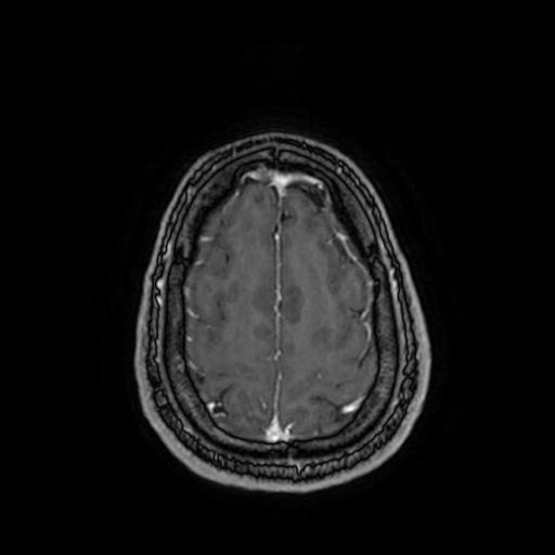File:Cerebellar hemangioblastoma (Radiopaedia 88055-104622 Axial T1 C+ 146).jpg