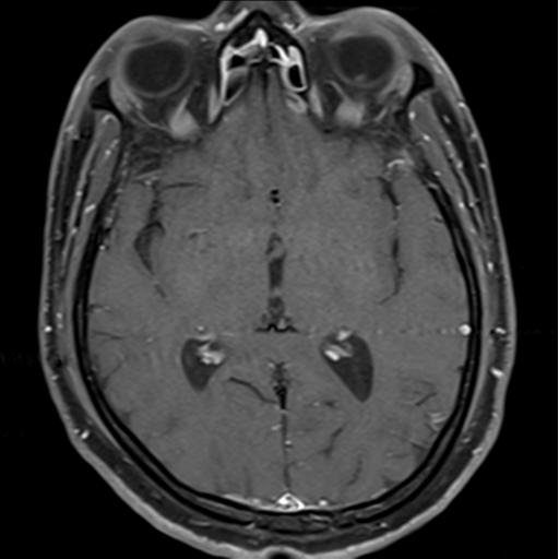 File:Cerebellar hemangioblastomas and pituitary adenoma (Radiopaedia 85490-101176 Axial T1 C+ fat sat 21).png