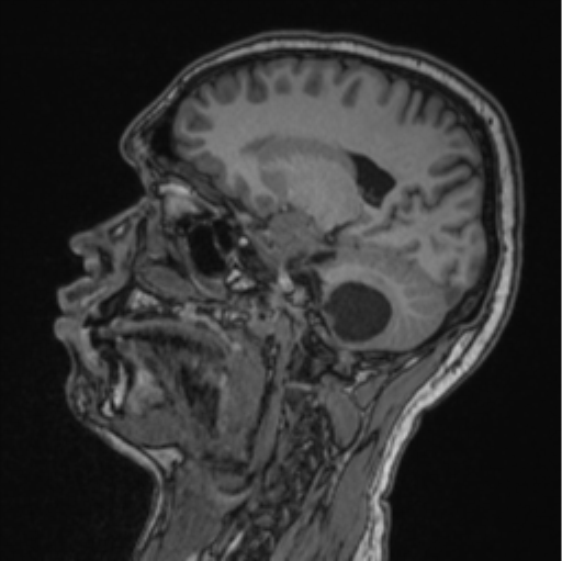 Cerebellar hemangioblastomas and pituitary adenoma (Radiopaedia 85490-101176 Sagittal T1 61).png