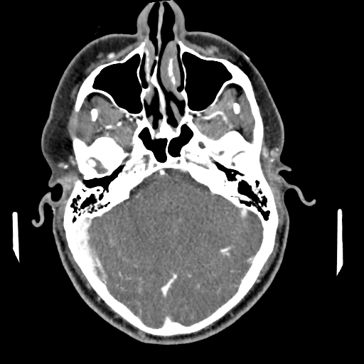 Cerebellar infarct due to vertebral artery dissection with posterior fossa decompression (Radiopaedia 82779-97029 C 16).png