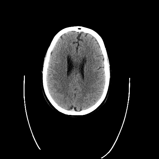 File:Cerebellar infarct due to vertebral artery dissection with posterior fossa decompression (Radiopaedia 82779-97033 Coronal non-contrast 1).png