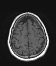 File:Cerebellar metastasis (Radiopaedia 54578-60810 Axial T1 31).png