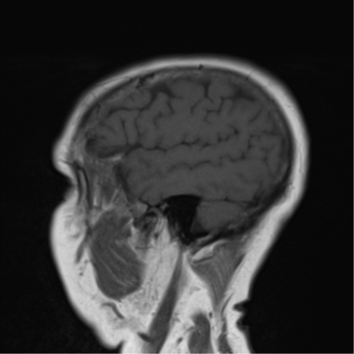 File:Cerebellar metastasis (Radiopaedia 54578-60810 Sagittal T1 18).png