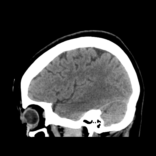 File:Cerebellar metastasis (cystic appearance) (Radiopaedia 41395-44258 E 42).png
