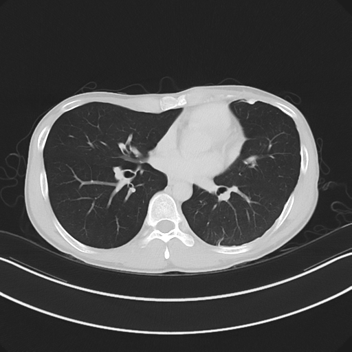 Cerebellar metastasis - adenocarcinoma lung (Radiopaedia 63184-71717 Axial lung window 40).png