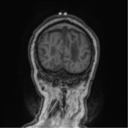 Cerebellar metastasis from lung adenocarcinoma (Radiopaedia 86690-102829 Coronal T1 12).png