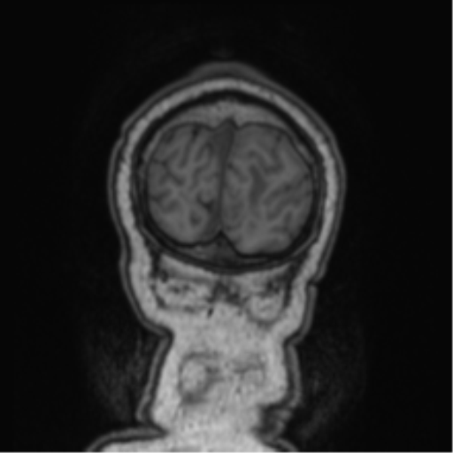 Cerebellar metastasis from lung adenocarcinoma (Radiopaedia 86690-102829 Coronal T1 9).png