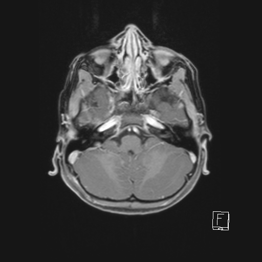 Cerebellar stroke (Radiopaedia 32202-33150 Axial T1 C+ 23).png