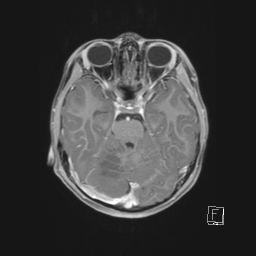 Cerebellar stroke (Radiopaedia 32202-33150 Axial T1 C+ 30).png