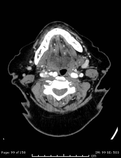 Cerebellar strokes due to intracranial giant cell arteritis (Radiopaedia 68799-78510 CT angiogram 99).jpg
