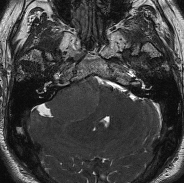 Cerebellopontine angle meningioma (Radiopaedia 24459-24764 I 20).jpg
