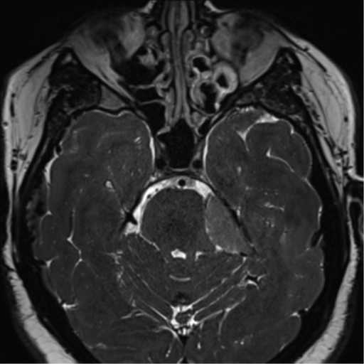 Cerebellopontine angle meningioma (Radiopaedia 48434-53348 Axial T2 Space 76).png