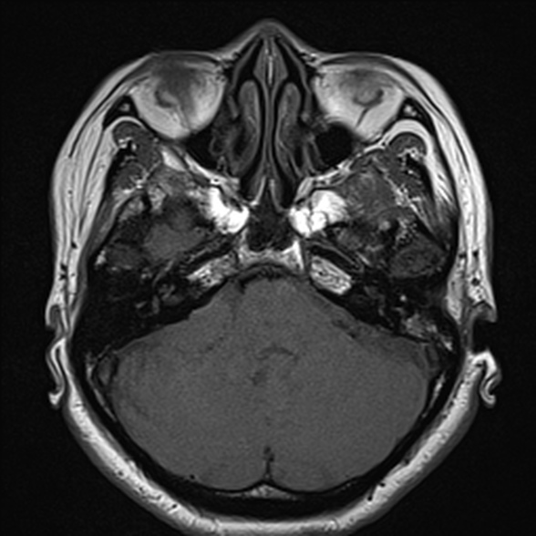 File:Cerebellopontine angle meningioma (Radiopaedia 53561-59591 Axial T1 10).jpg