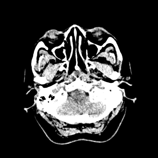 Cerebellopontine angle meningioma (Radiopaedia 53561-59592 Axial non-contrast 9).jpg