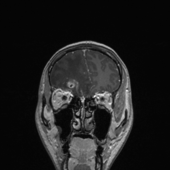Cerebral abscess (Radiopaedia 24212-24478 Coronal T1 C+ 56).jpg