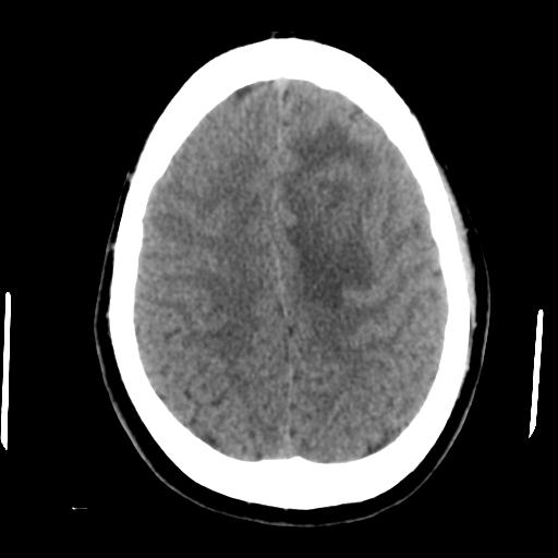 Cerebral abscess (Radiopaedia 29451-29919 Axial non-contrast 38).jpg