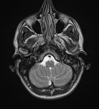 File:Cerebral abscess (Radiopaedia 60342-68009 Axial T2 4).png
